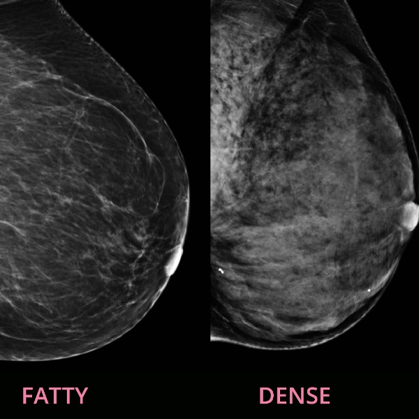 Qu’est-ce que la densité mammaire et en quoi est-elle importante ?
