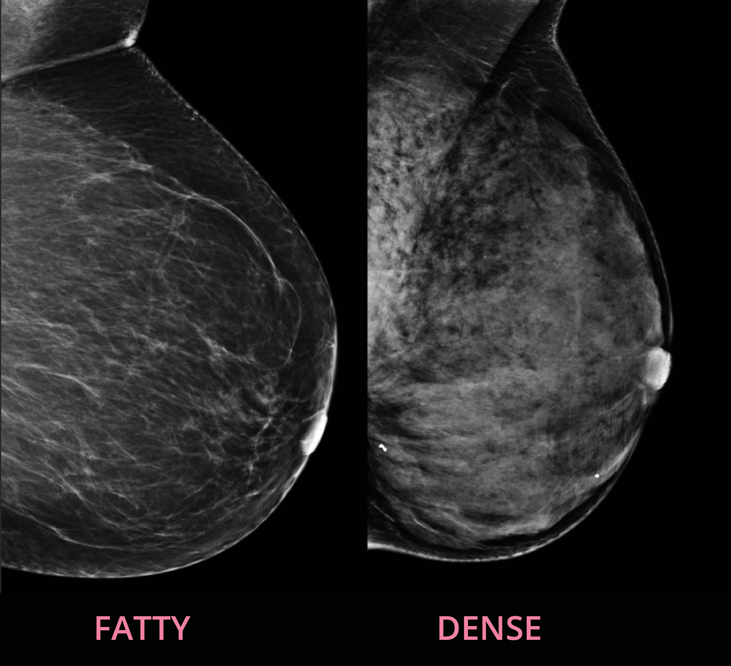 Dense breasts verus fatty breasts