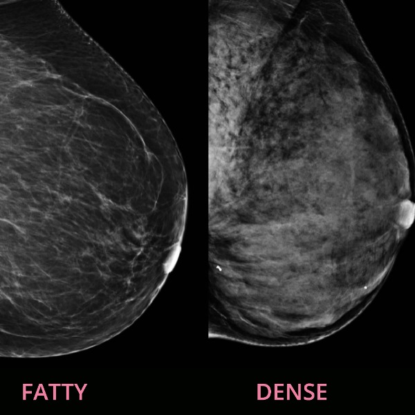 What I Wish I Had Known About Breast Cancer – Dense Breasts Canada