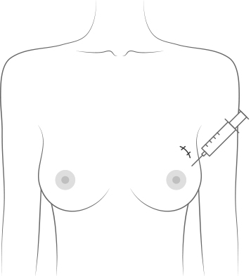 lipofilling