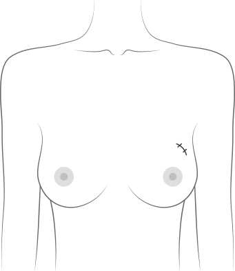 Lumpectomy