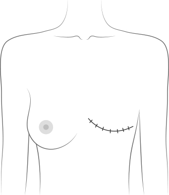 Mastectomy