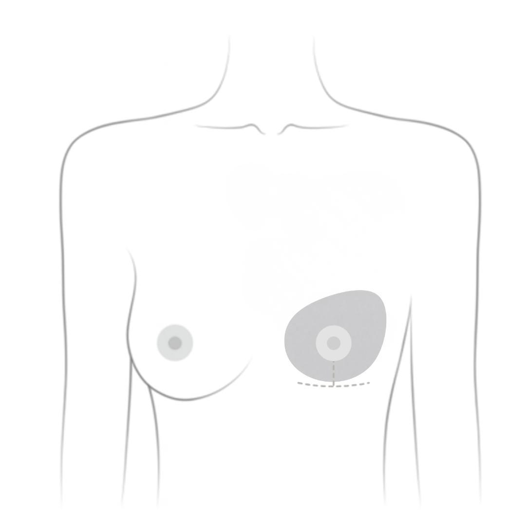 Mastectomy