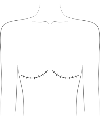 Prophylactic Mastectomy