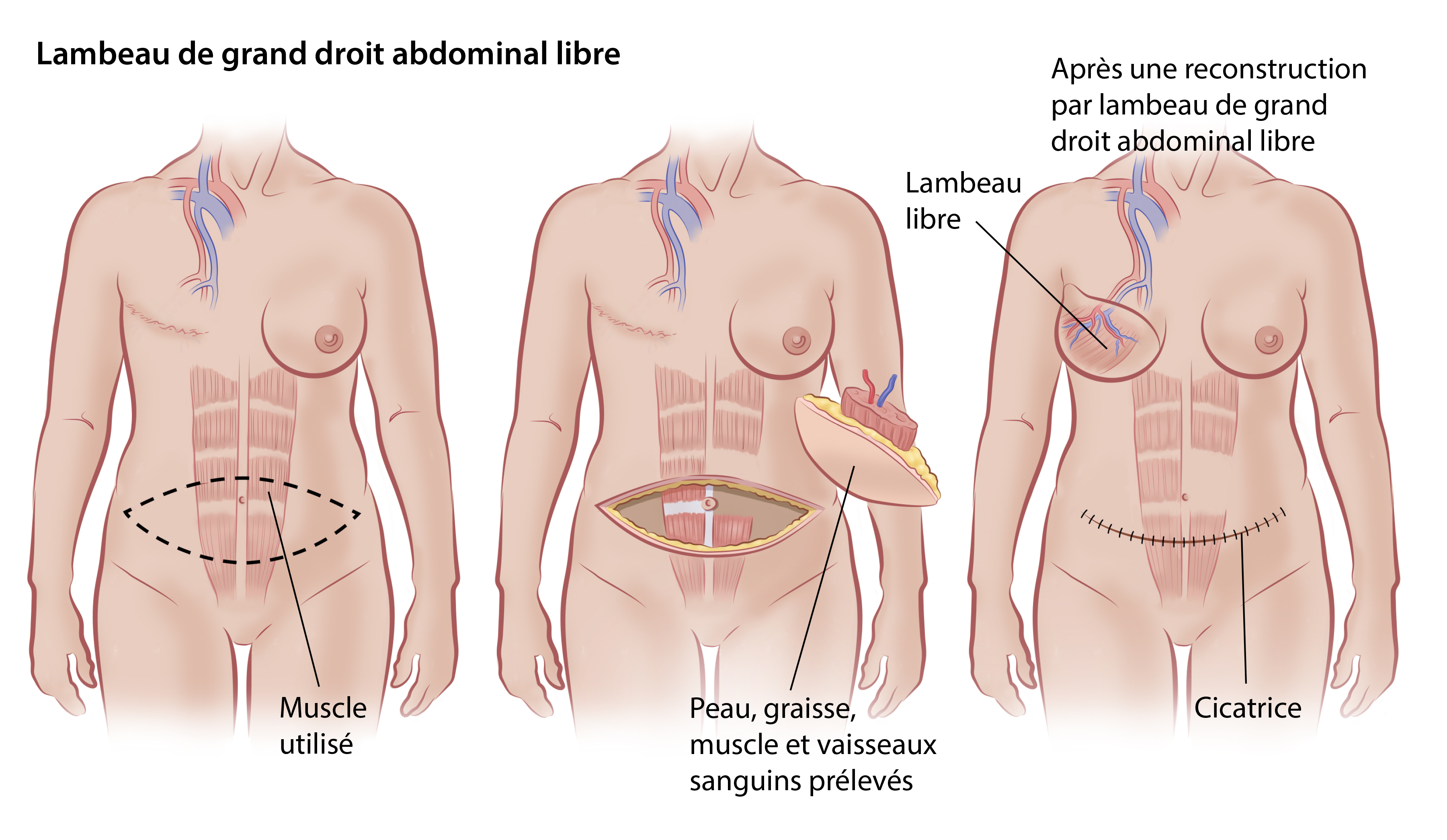  Lambeau de grand droit abdominal libre