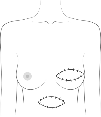 Autologous Reconstruction