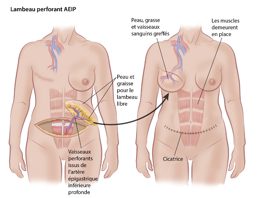 Lambeau perforant AEIP