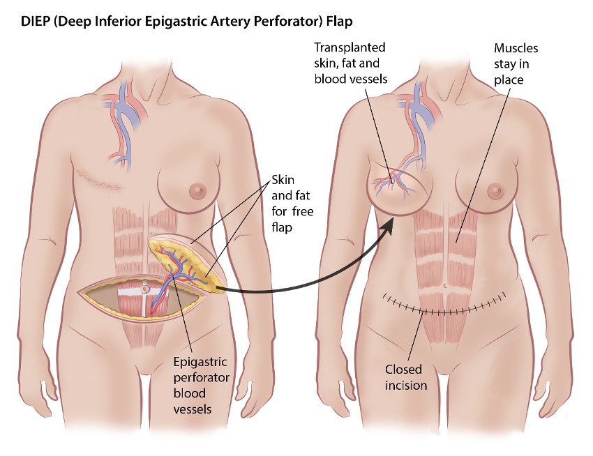 DIEP Flap