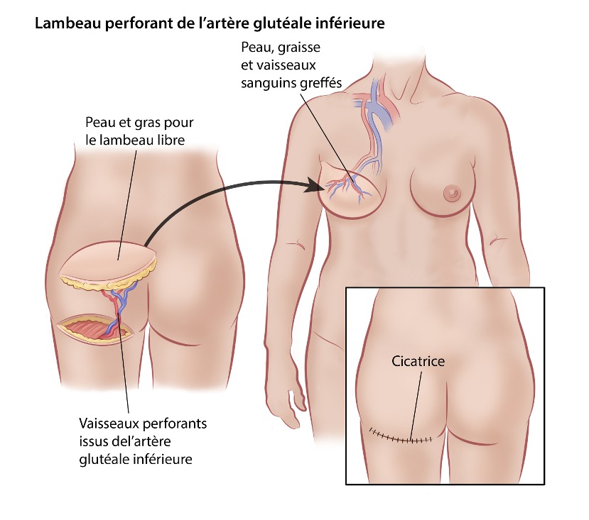  Lambeau perforant de l’artère glutéale inférieure 