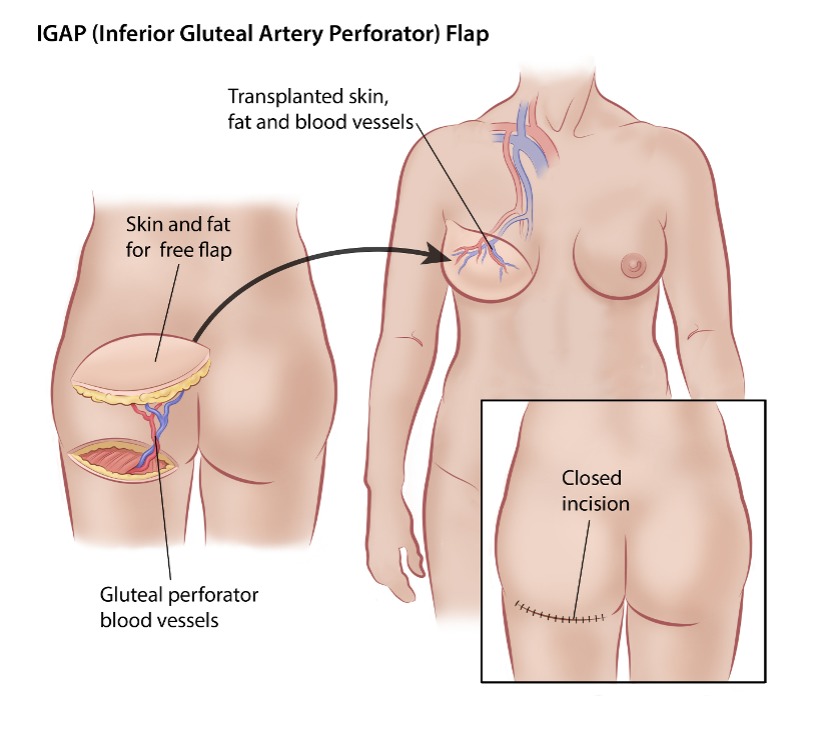 Autologous Reconstruction, SurgeryGuide - Canadian Breast Cancer