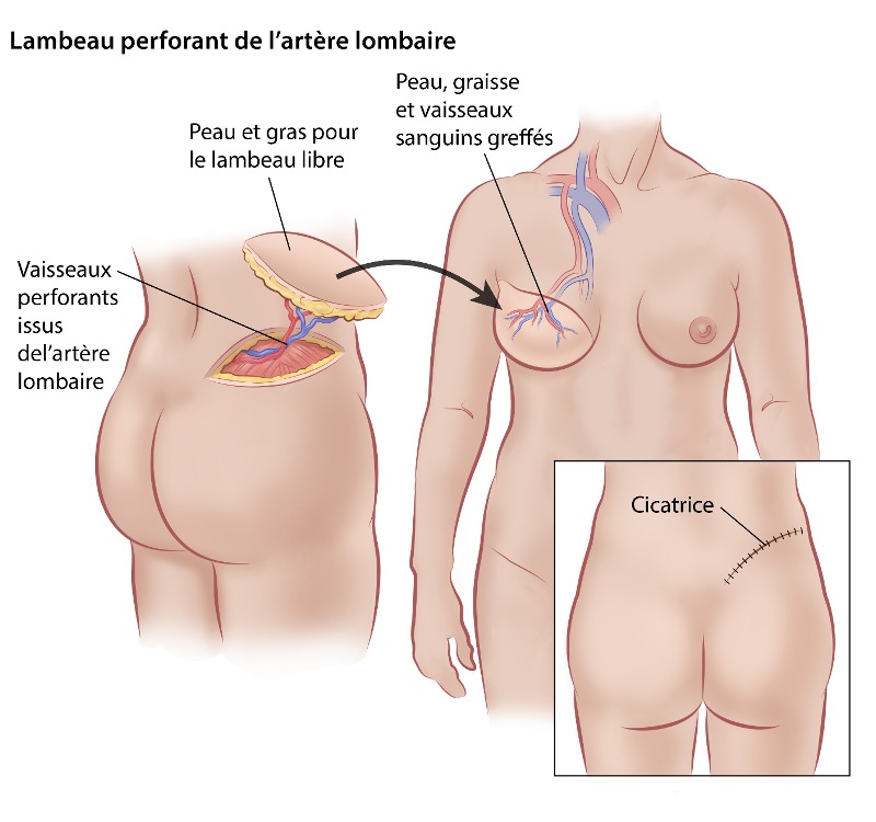  Lambeau perforant de l’artère lombaire