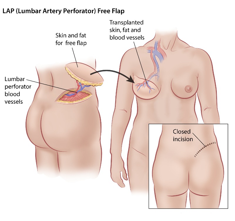 Stage C Autologous Breast Reconstruction – Medical Stock Images Company