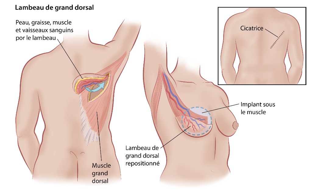  Lambeau de grand dorsal