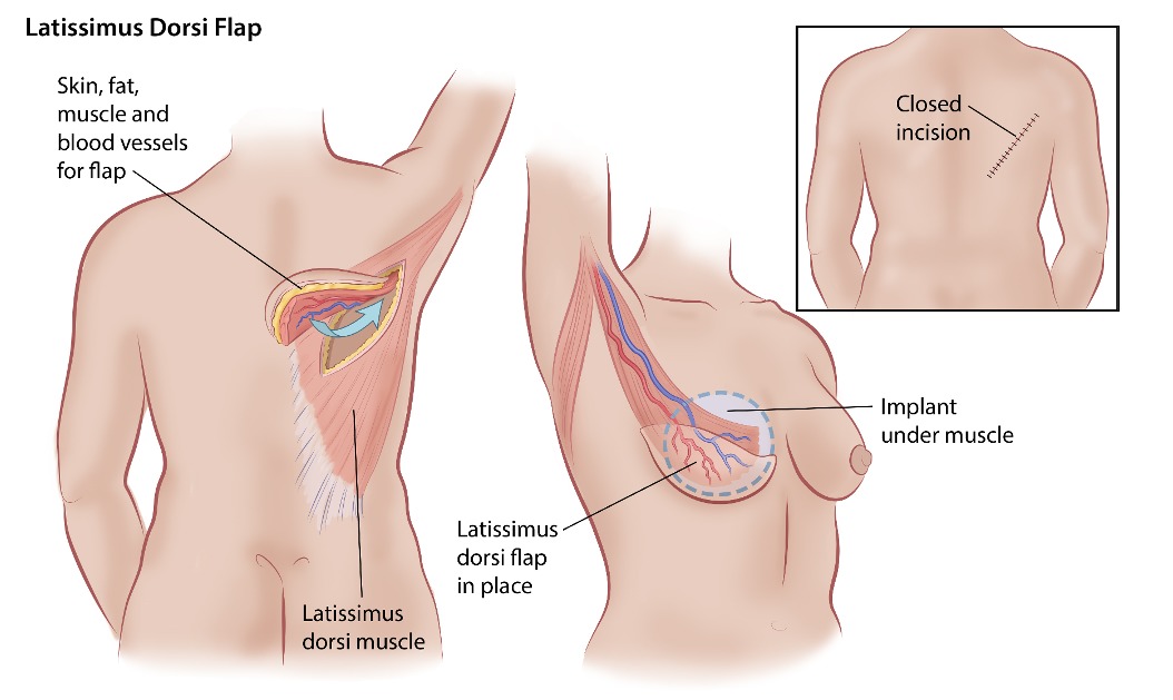 Stage C Autologous Breast Reconstruction – Medical Stock Images Company