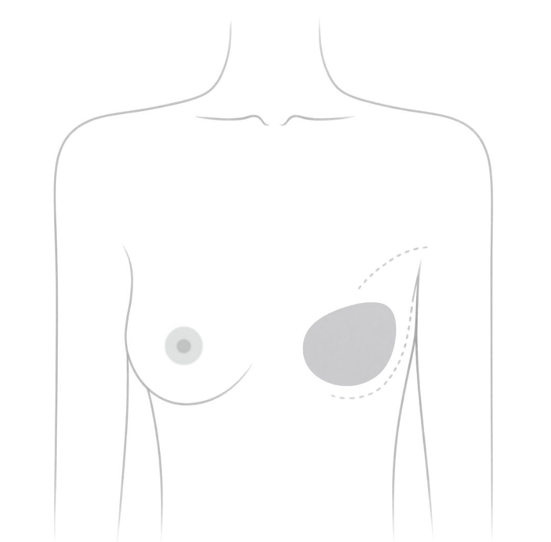 Mastectomy