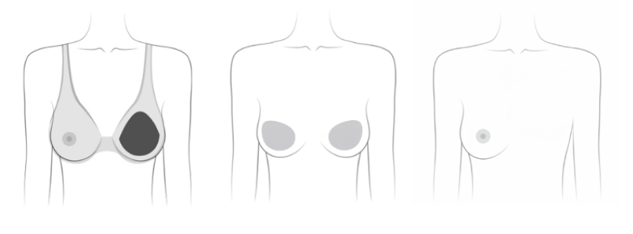 Options after mastectomy