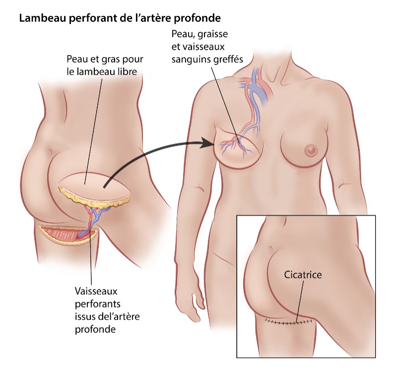 Lambeau libre perforant de l’artère profonde (PAP)