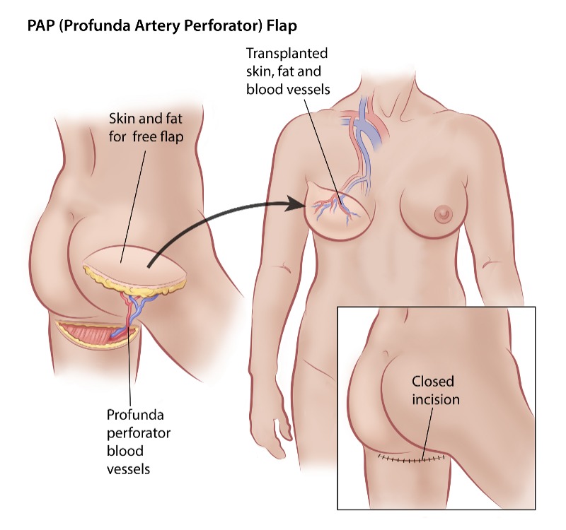 PAP free flap