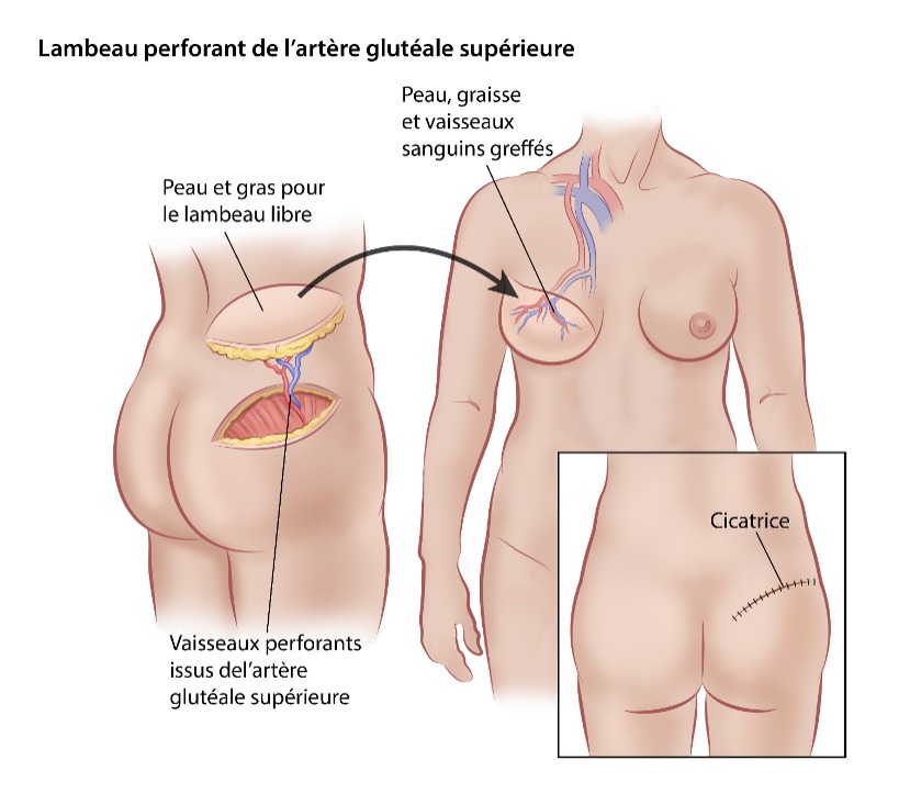 Lambeau perforant de l’artère glutéale supérieure