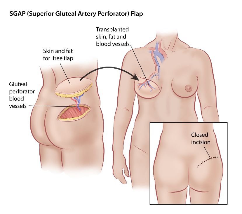 AAPS - Autologous Breast Augmentation With Incision Free Flaps