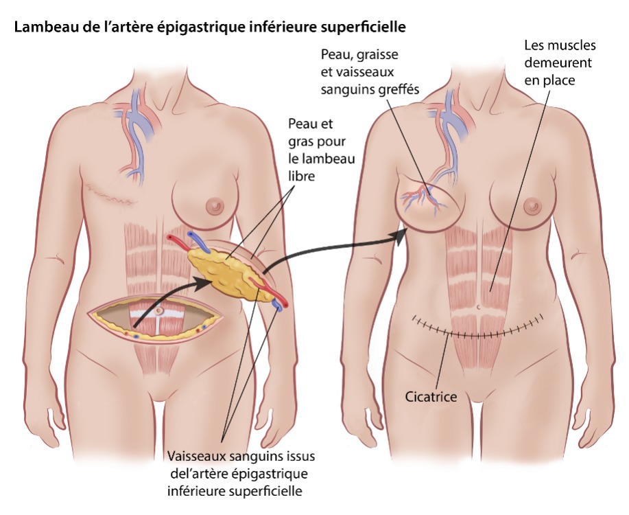 Lambeau de l’artère épigastrique inférieure superficielle