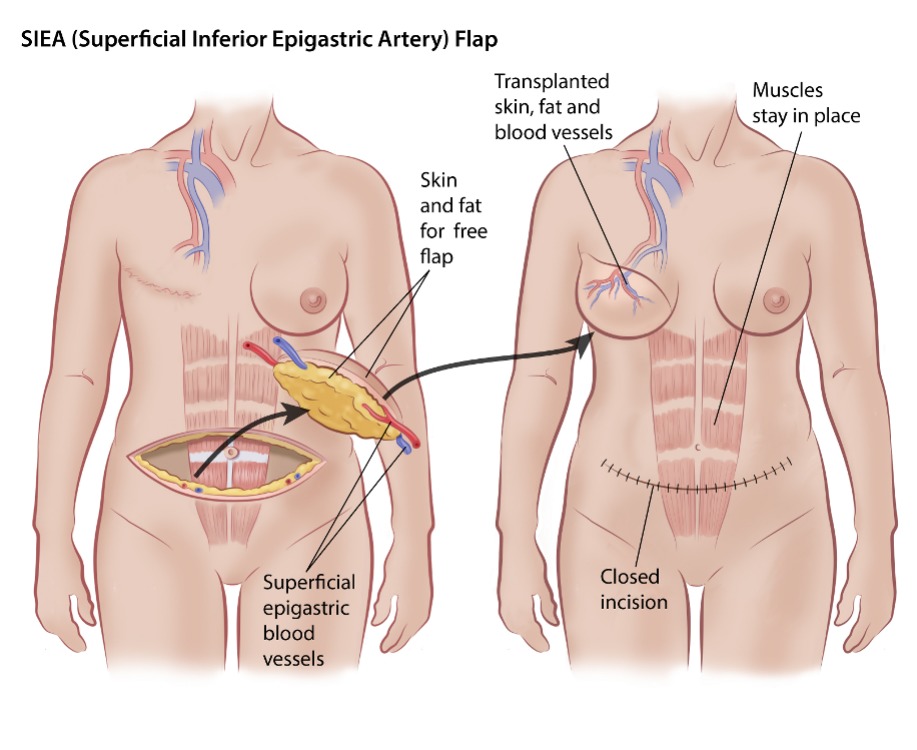 Autologous Reconstruction, SurgeryGuide - Canadian Breast Cancer Network