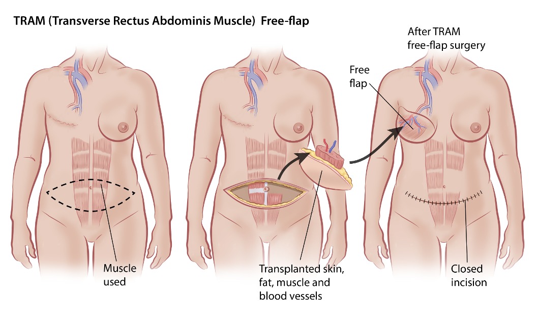 Autologous Reconstruction, SurgeryGuide - Canadian Breast Cancer