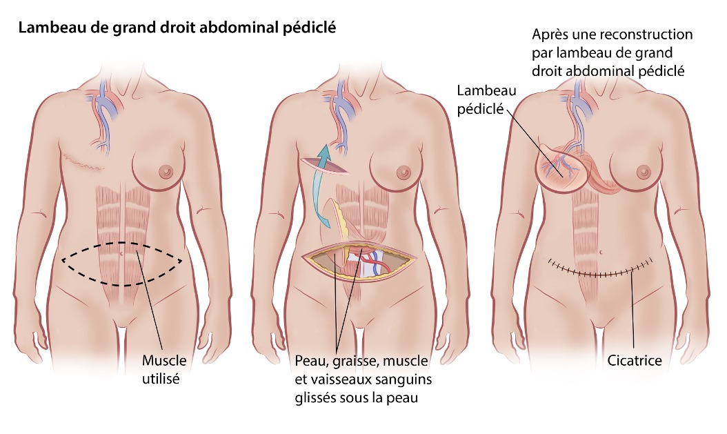  Lambeau de grand droit abdominal pédiclé