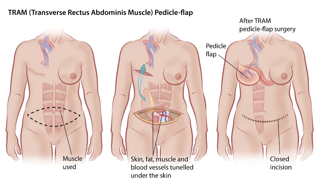 TRAM pedicle flap