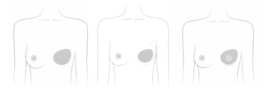 Types of mastectomies